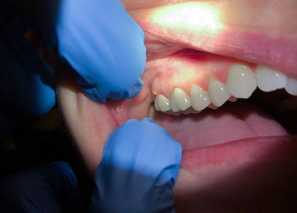 Best Emergency Tooth Extraction in Harwich Center, MA