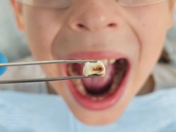 Best Emergency Tooth Extraction in Harwich Center, MA